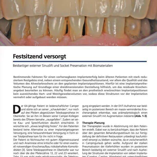 Festsitzend versorgt. Beidseitiger externer Sinuslift